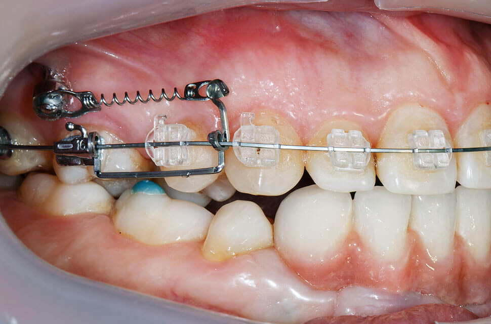 矯正用アンカースクリューを用いた矯正治療