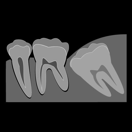 「18歳の方へ」3月で終了する「医療費助成」。親知らずの相談はお早めに