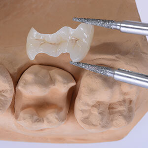 セラミックによる白い歯治療