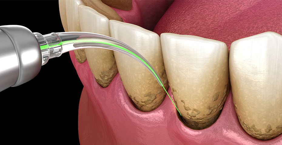 レーザーによる歯周ポケットの治療