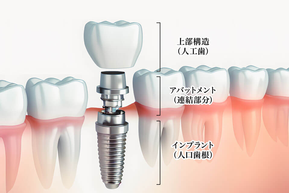 インプラント埋入治療とは